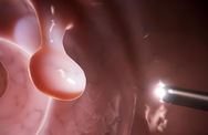 95% ca ung thư đại tràng liên quan đến nguyên nhân này, làm sao để phòng bệnh đúng cách?