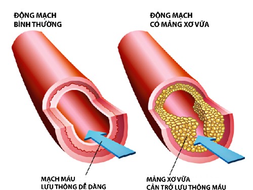 Ba điều cần biết về máu nhiễm mỡ