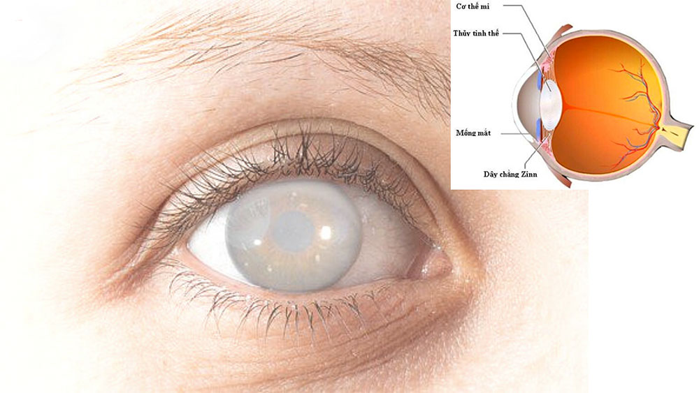 Nhận biết sớm đục thủy tinh thể, thủ phạm nguy hiểm gây mù lòa