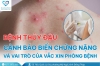 Bệnh thủy đậu: Cảnh báo biến chứng nặng và vai trò của vắc xin phòng bệnh