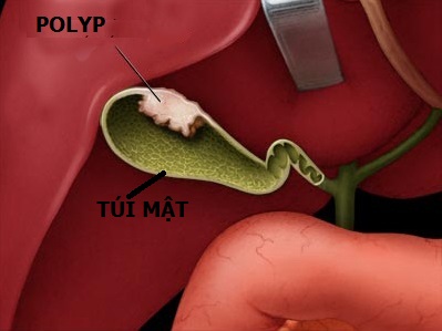 POLYP TÚI MẬT: Khi nào nên phẫu thuật?