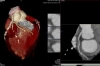 Nhiều người bệnh biết sớm nguyên nhân nhồi máu cơ tim cấp nhờ Chụp CTscan mạch vành