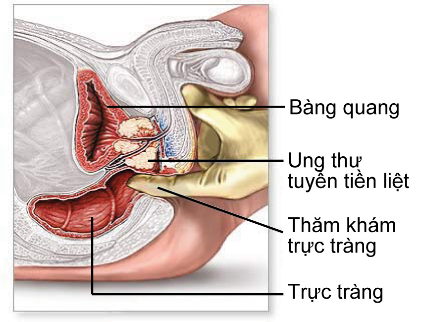 Ý nghĩa việc phát hiện sớm ung thư tuyến tiền liệt