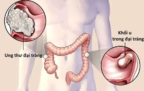 Bao lâu nên nội soi kiểm tra ung thư đại trực tràng