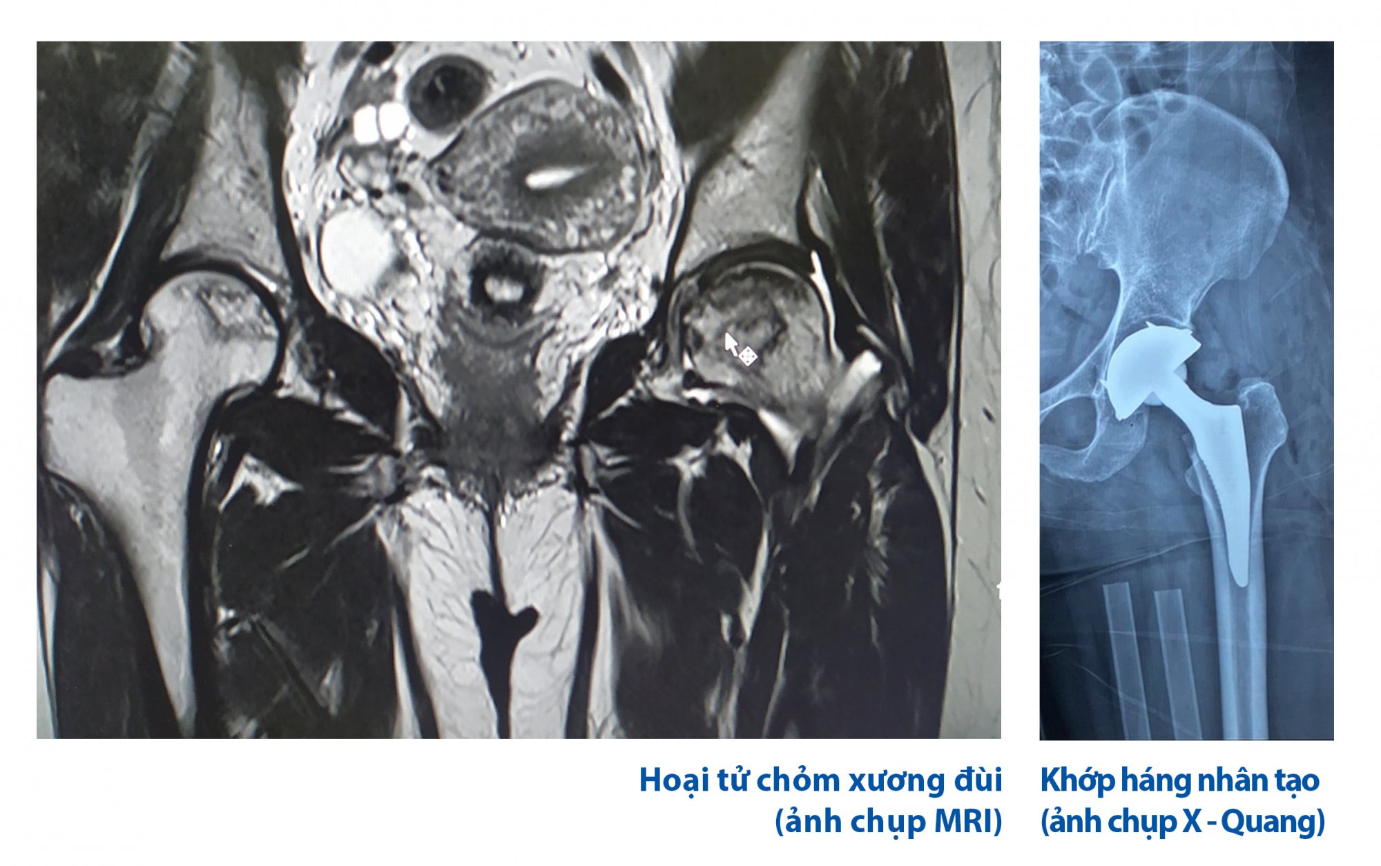 Phẫu thuật thay khớp háng nhân tạo cho bệnh nhân hoại tử chỏm xương đùi