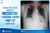 Khám sức khỏe định kỳ - Phát hiện "xương sườn thứ 13" hiếm gặp