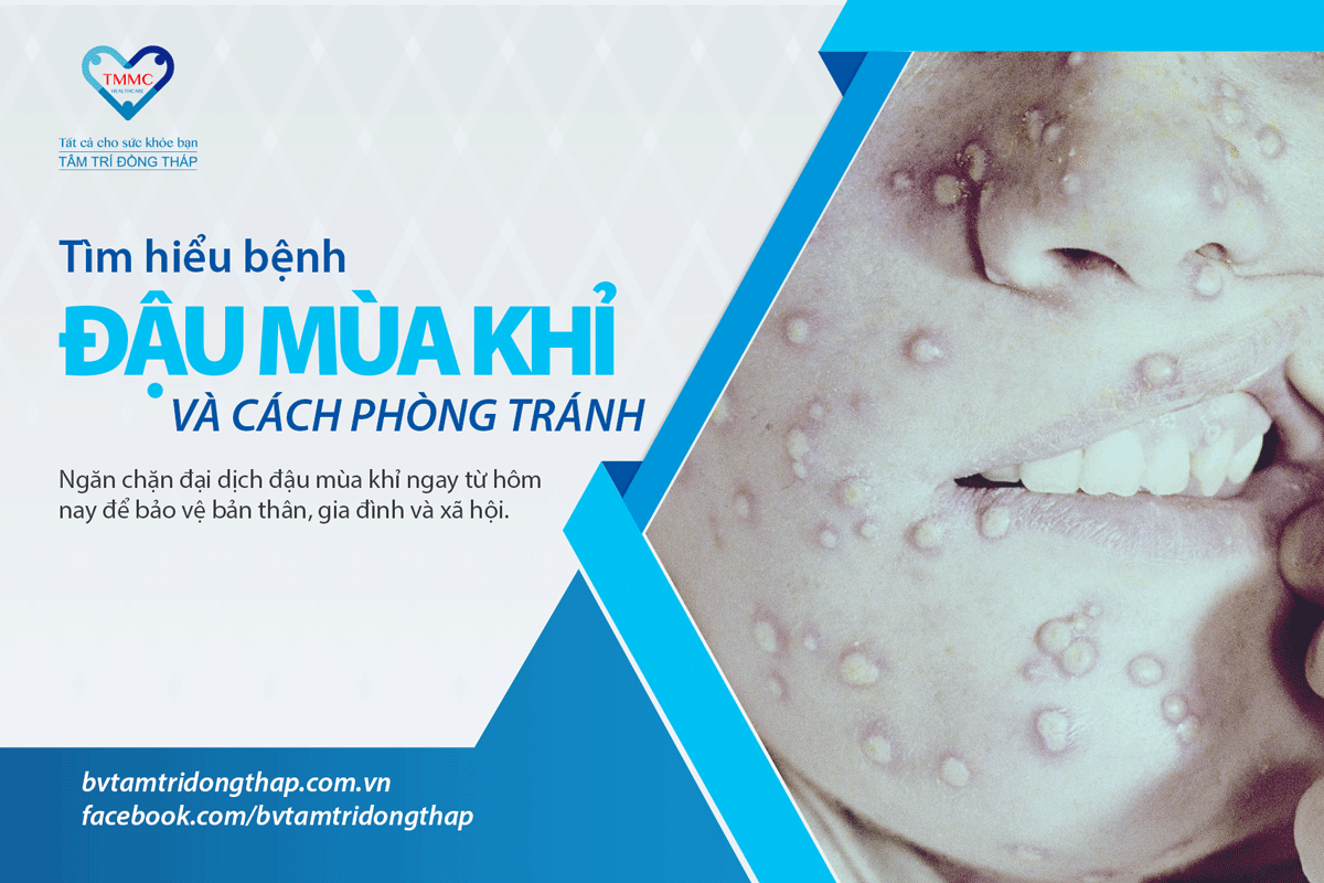 Đậu mùa khỉ: những thông tin cần biết và cách phòng ngừa