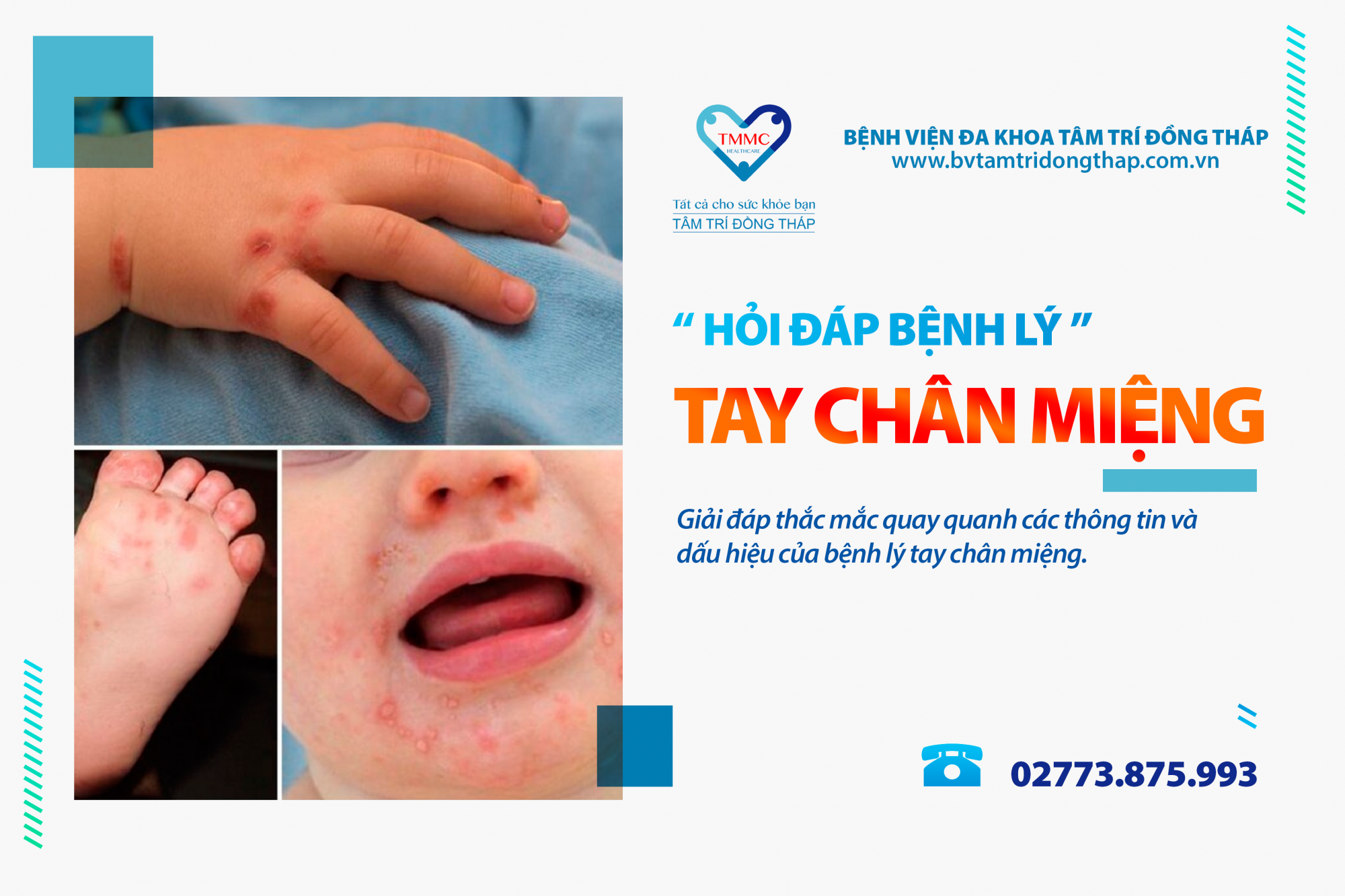 Hỏi đáp bệnh lý: Giải đáp các câu hỏi về bệnh lý tay chân miệng
