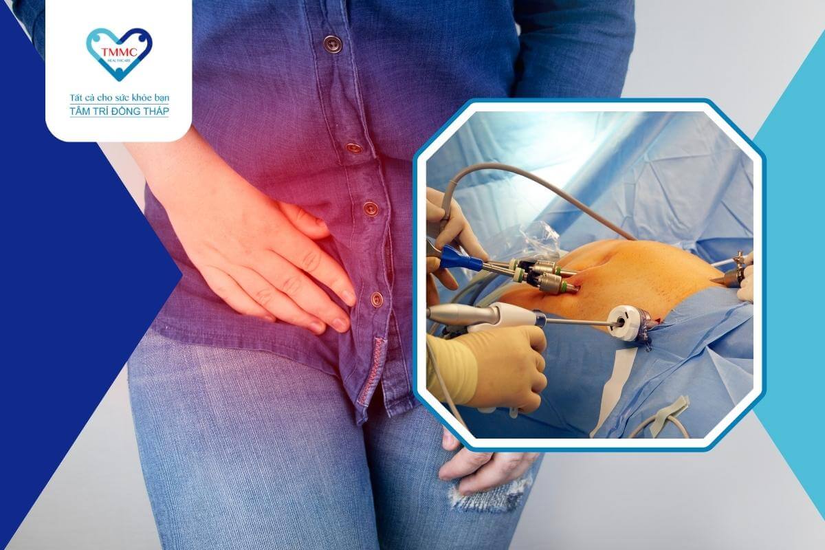 Viêm ruột thừa: phục hồi nhanh chóng với phẫu thuật nội soi tại Tâm Trí Đồng Tháp