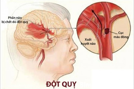 Làm sao để ngăn ngừa đột quỵ?