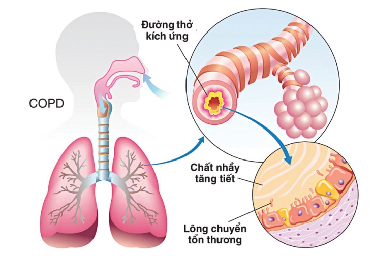 Bệnh phổi tắc nghẽn mạn tính (COPD)