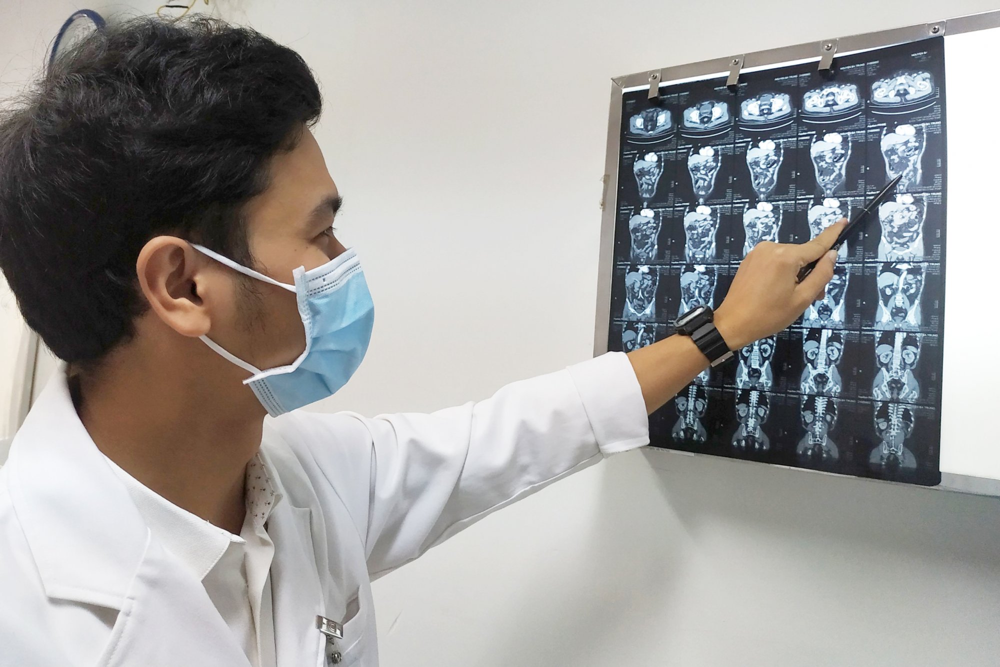 Xương cá hình cánh cung đâm thủng ruột non