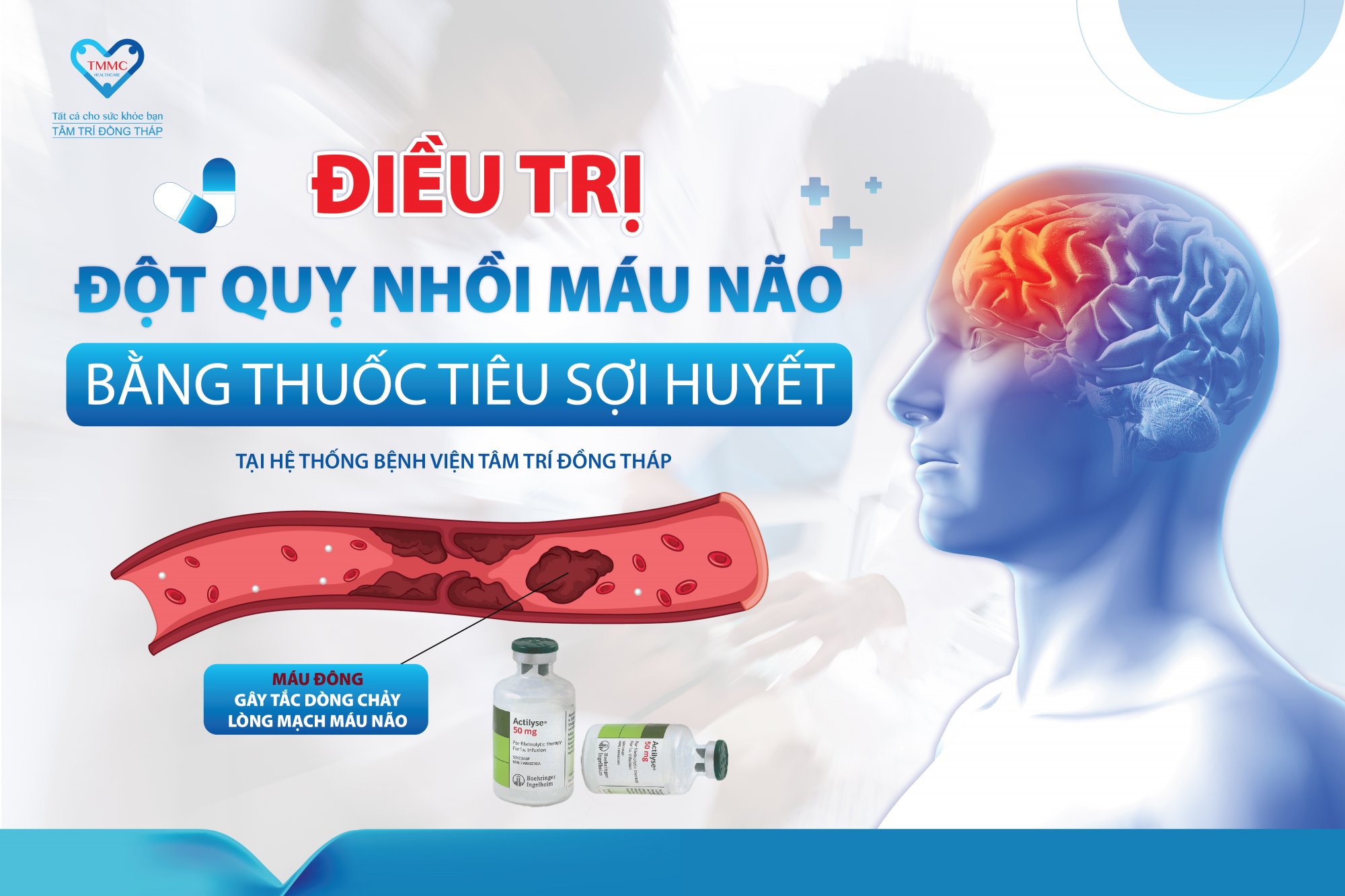 Điều trị đột quỵ nhồi máu não bằng thuốc tiêu sợi huyết