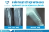 Phẫu thuật kết hợp xương đùi bị gãy phức tạp cho bệnh nhân lớn tuổi