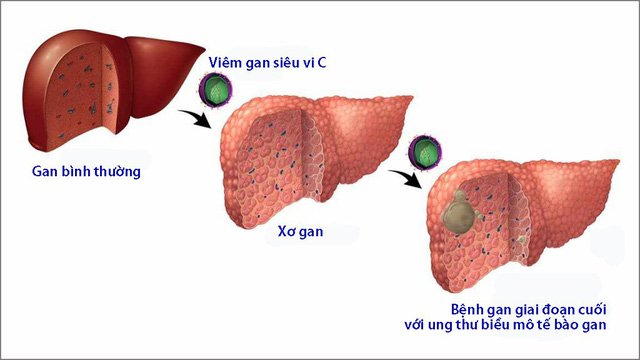 Tầm soát vi rút viêm gan C (Screening for Hepatitis C Virus)