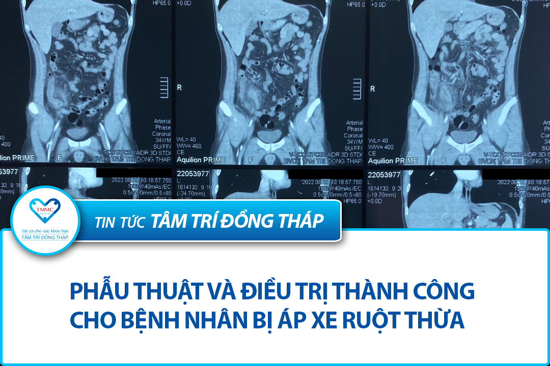 Phẫu thuật và điều trị thành công cho bệnh nhân bị áp xe ruột thừa