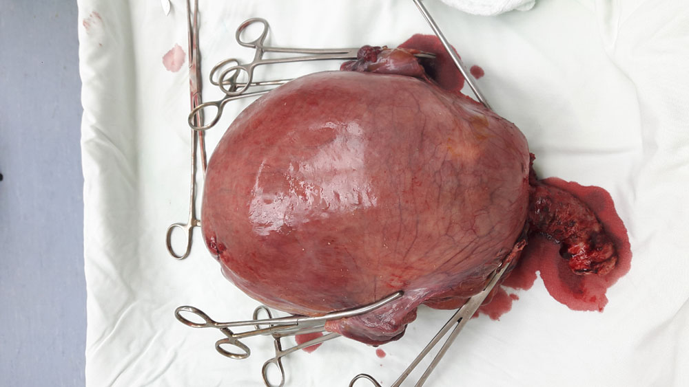 Phẫu thuật thành công u xơ tử cung nặng 3,9 kg