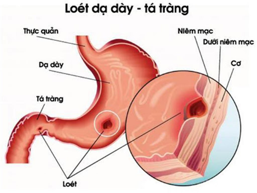 Thuốc nào gây hại dạ dày?