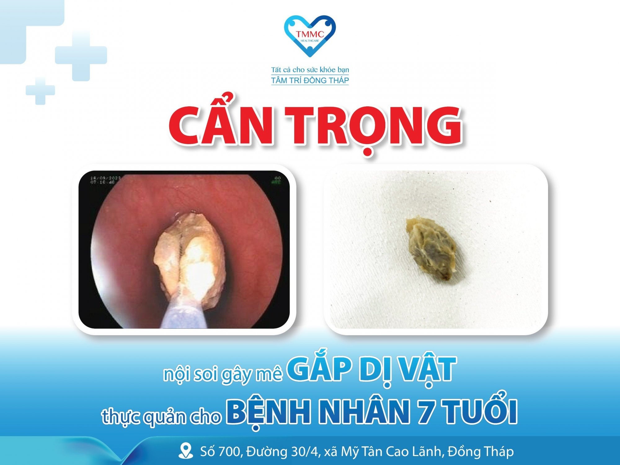 Nội soi gây mê gắp dị vật thực quản cho bệnh nhân 7 tuổi