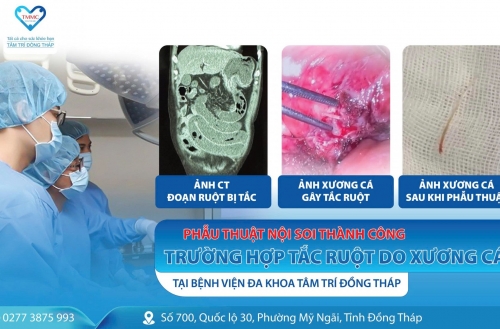 Tâm Trí Đồng Tháp phẫu thuật nội soi thành công trường hợp tắc ruột do xương cá