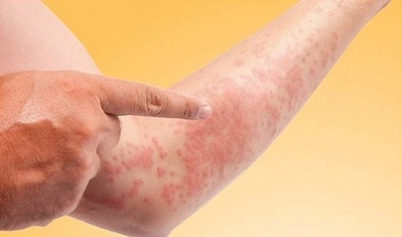 Chuyên mục Sống Khỏe: Nổi mề đay, căn bệnh da liễu ai cũng có thể mắc nhưng hiếm khi hiểu rõ