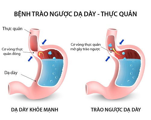 trao-nguoc-da-day-la-gi-1