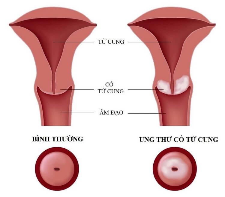 benh-ung-thu-co-tu-cung