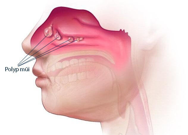 polyp-mui-xoang