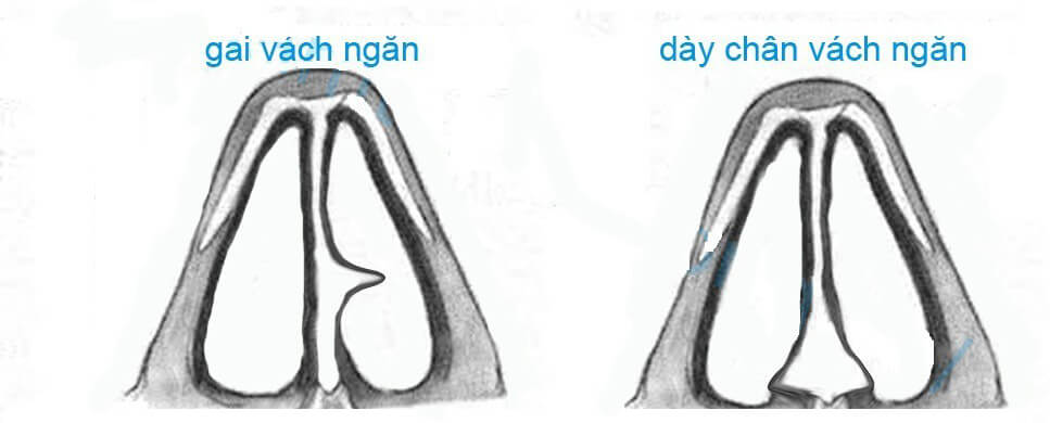 vach-ngan-mui