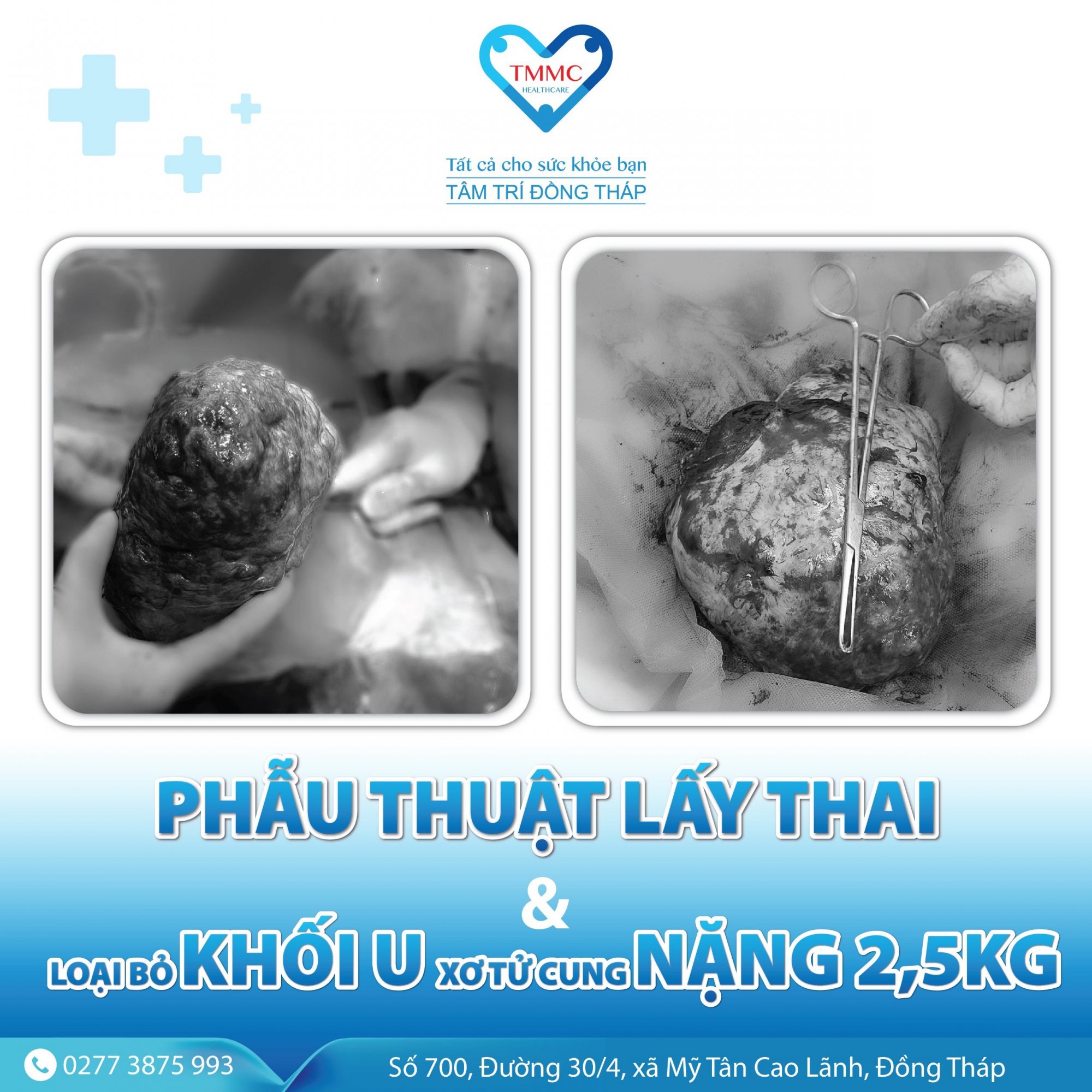 Phẫu thuật lấy thai cho sản phụ đồng thời loại bỏ khối u xơ tử cung nặng 2,5kg
