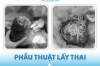 Phẫu thuật lấy thai cho sản phụ đồng thời loại bỏ khối u xơ tử cung nặng 2,5kg