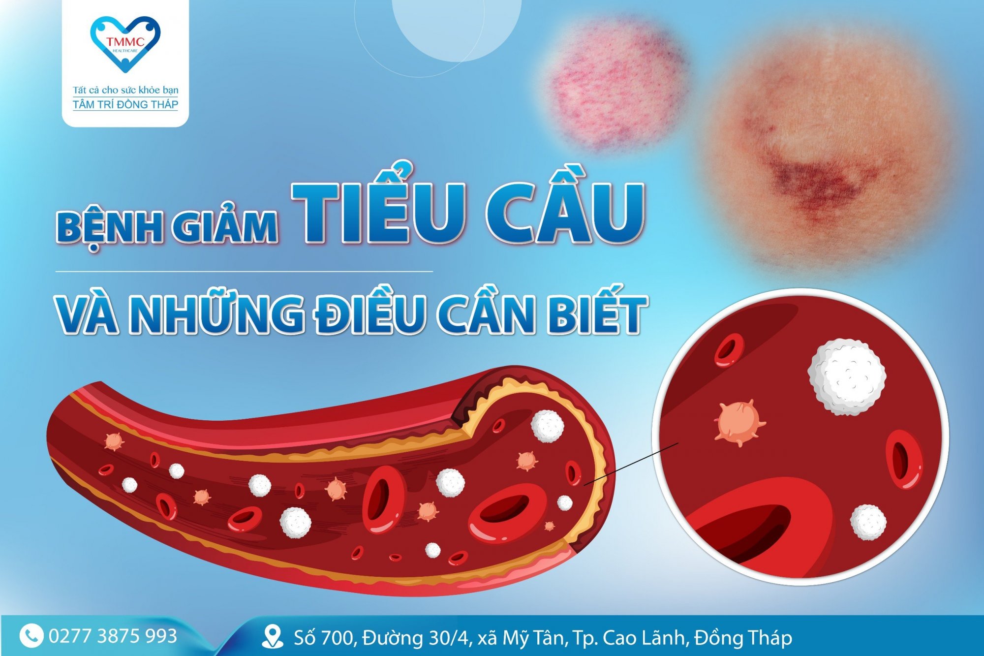 Bệnh giảm tiểu cầu và những điều cần biết