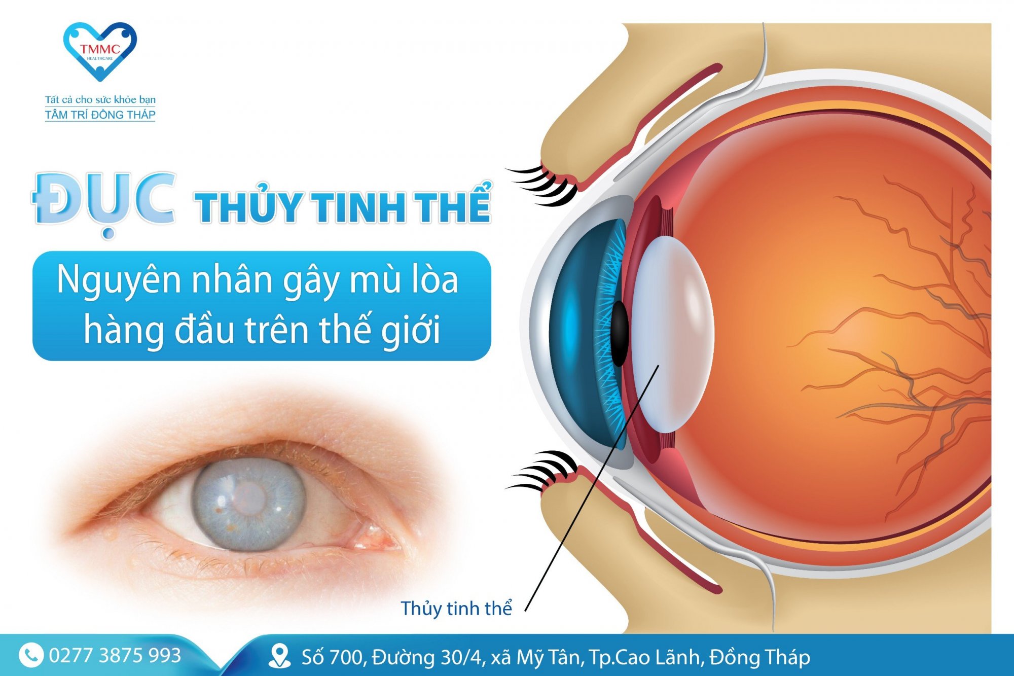 Đục thủy tinh thể - nguyên nhân gây mù lòa hàng đầu trên thế giới