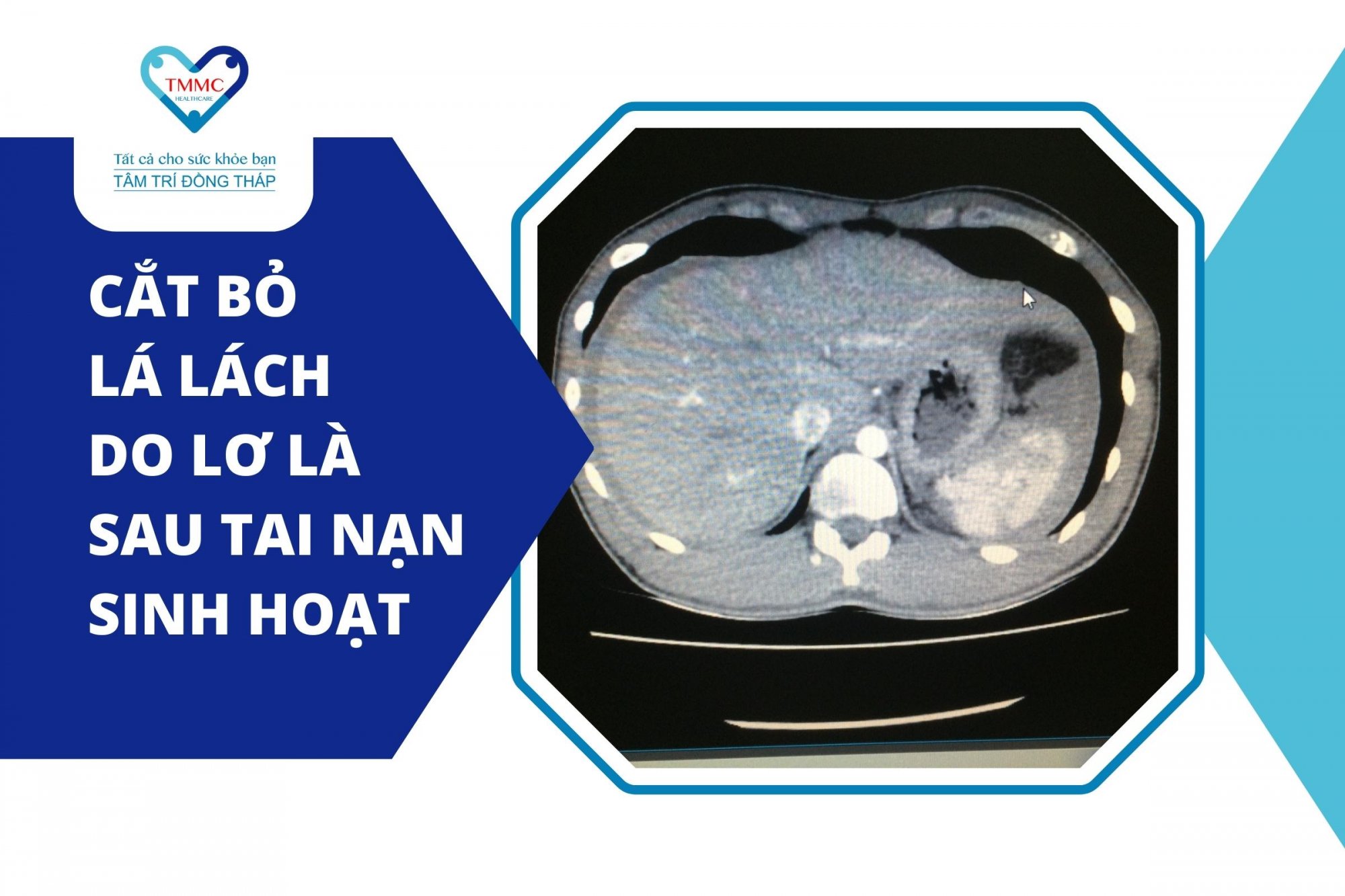 Cắt bỏ lá lách do lơ là sau tai nạn sinh hoạt