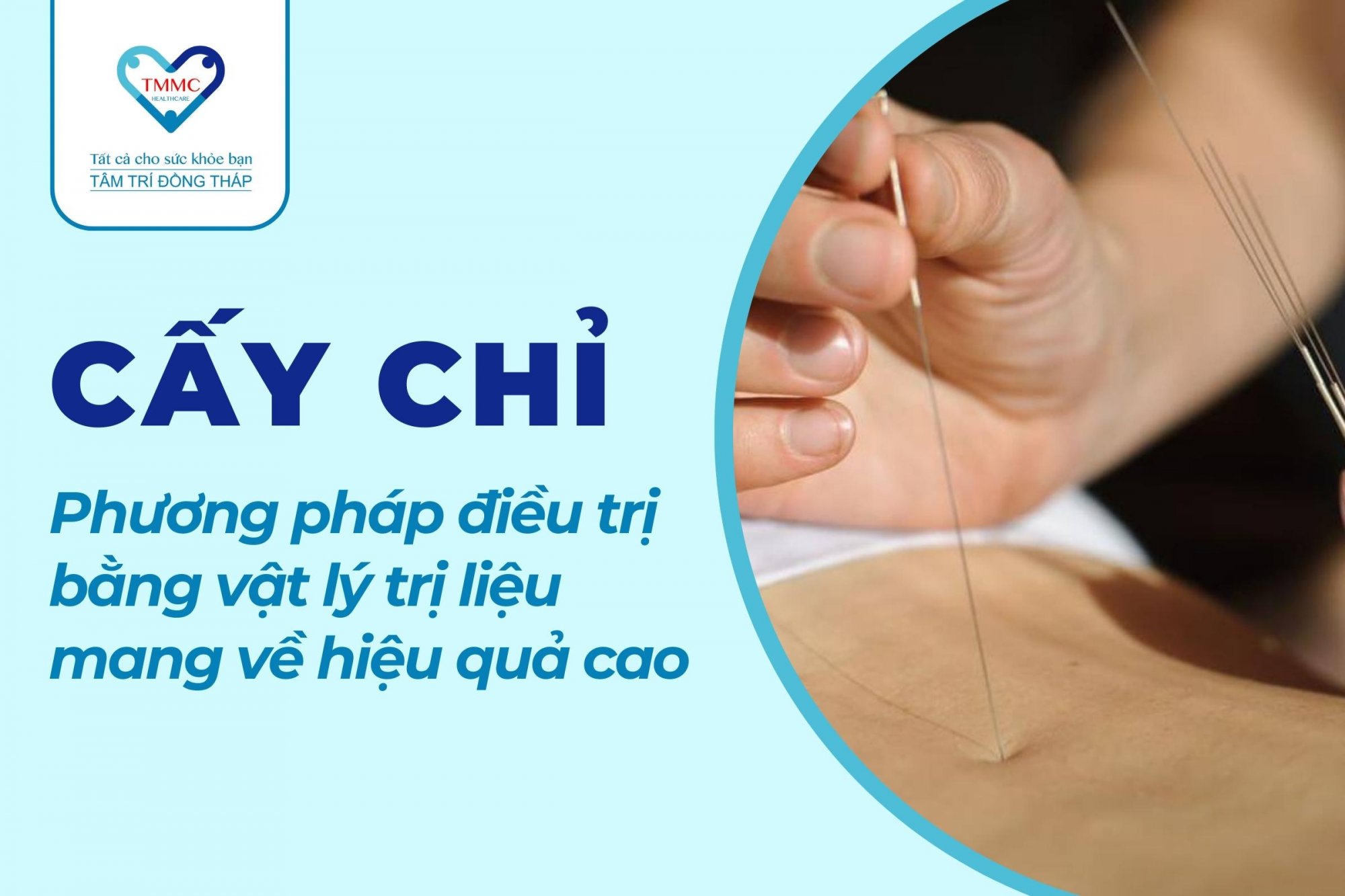 Cấy chỉ - Phương pháp điều trị mang về hiệu quả tối ưu