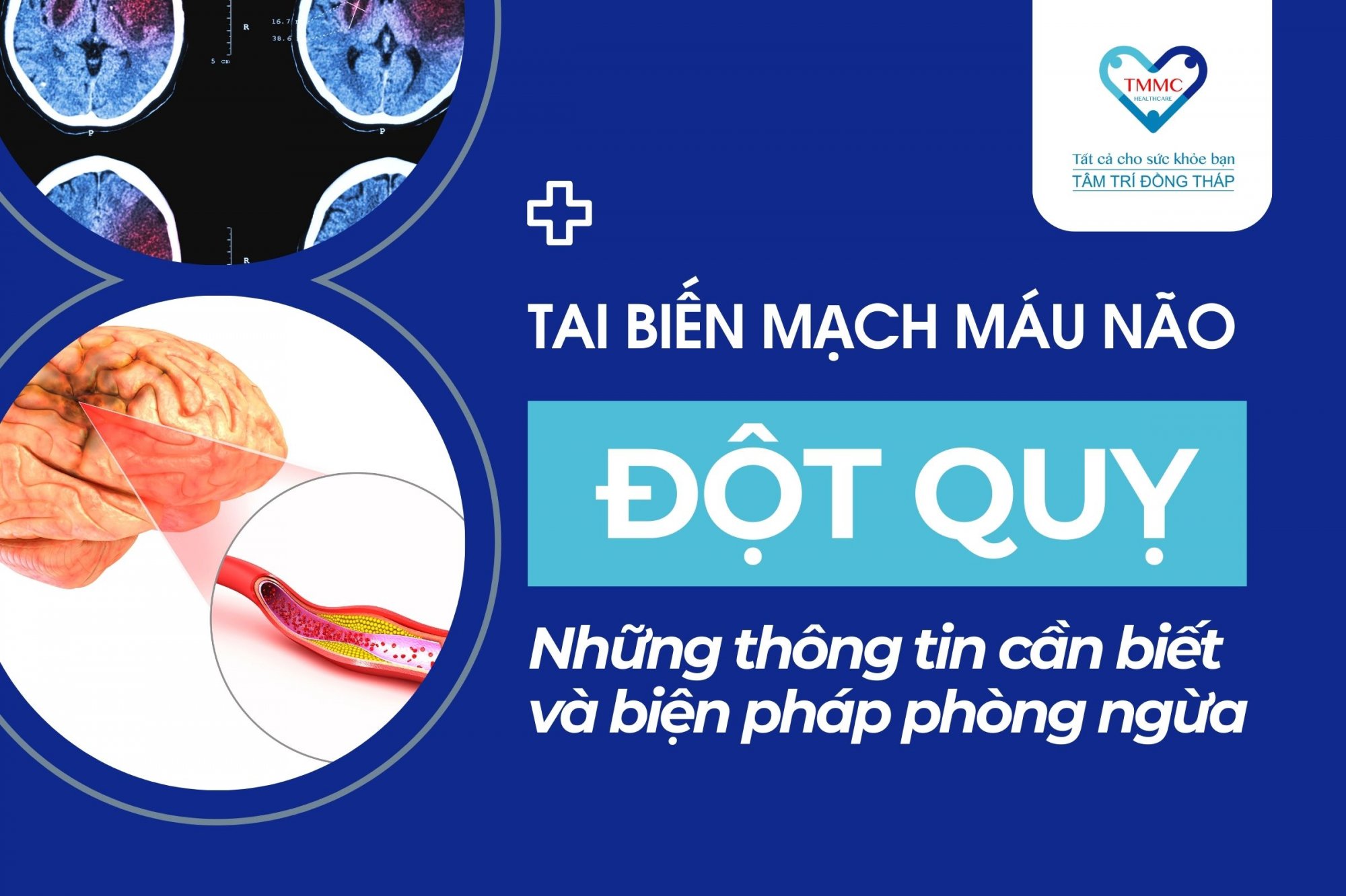 Tai biến mạch máu não: thông tin cần biết và cách phòng ngừa