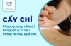 Cấy chỉ - Phương pháp điều trị bằng vật lý trị liệu mang về hiệu quả cao