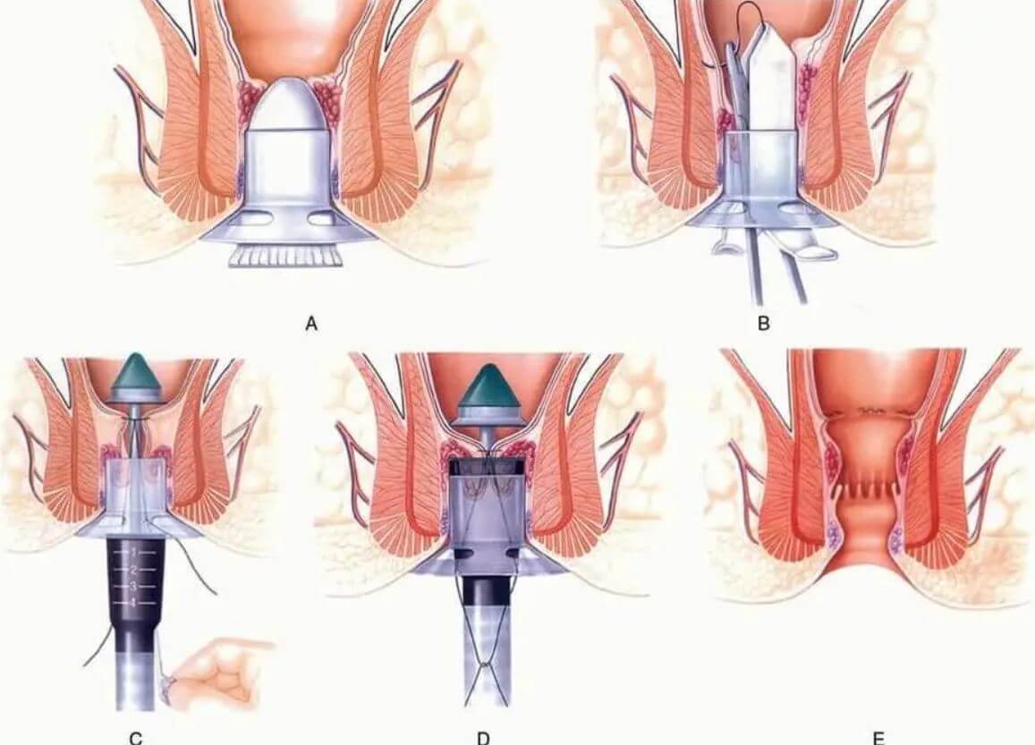 Bệnh viện Tâm Trí Đồng Tháp: Phẫu thuật trĩ bằng phương pháp Longo, ít đau, hồi phục nhanh