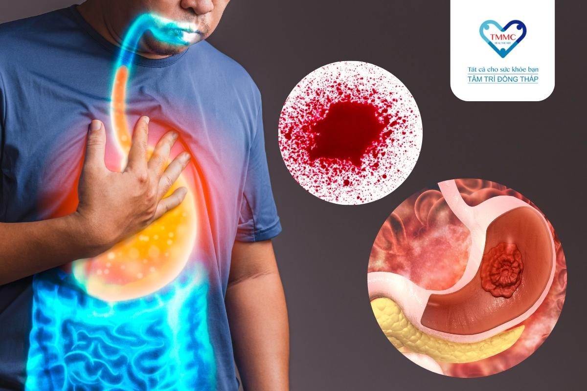 Cấp cứu và điều trị thành công cho bệnh nhân nôn ra máu mức độ nặng