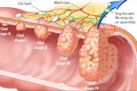 Tầm soát bệnh ung thư đại tràng