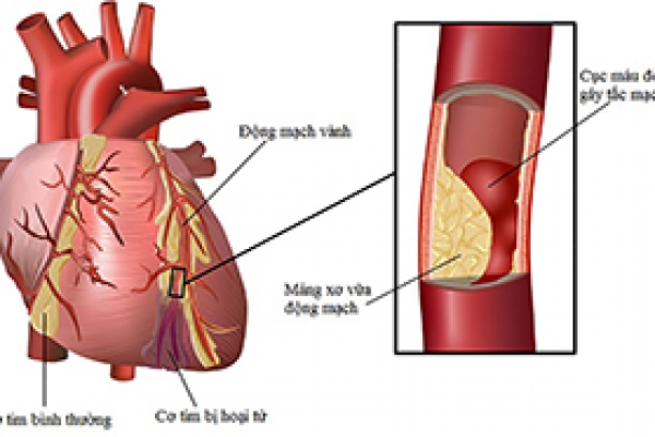 Tầm soát bệnh mạch vành