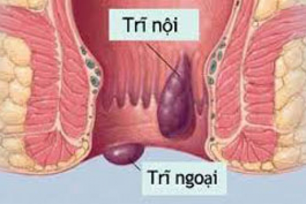 Phẫu thuật trĩ bằng Longo